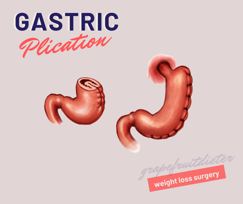 gastric plication weight loss surgery