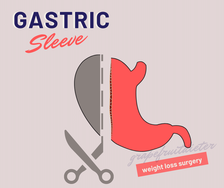 gastric sleeve surgery