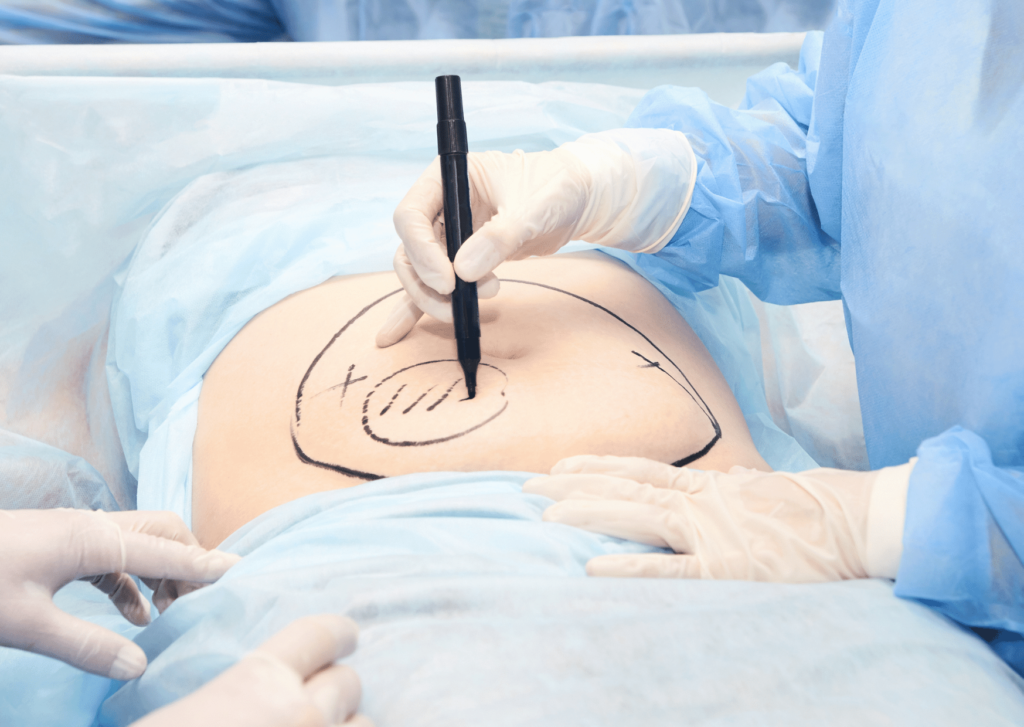 Abdominoplasty surgery