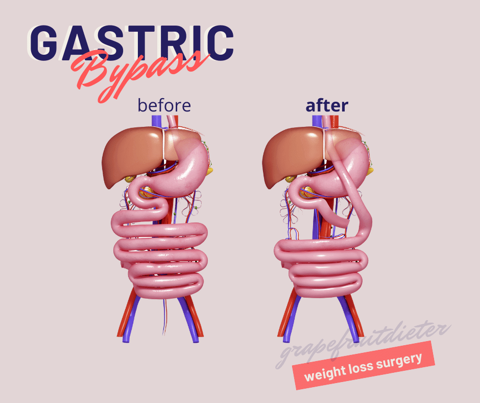 laparoscopic gastric bypass surgery