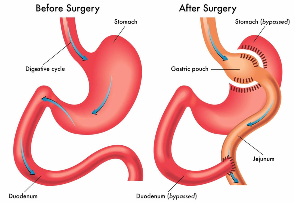 Gastric bpass surgery